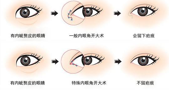 拯救小眼睛的开内眼角手术