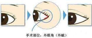 开外眼角手术的过程是怎么样的
