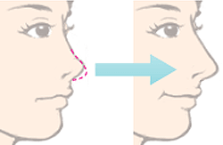 鼻尖整形包括哪些内容