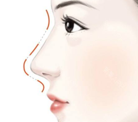 歪鼻矫正术的过程是怎样的