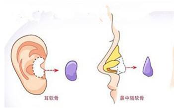 什么是鼻小柱延长整形