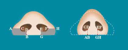 详细了解鼻翼缩小术