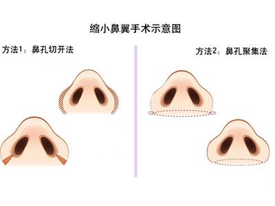 鼻翼缩小手术的过程是怎样进行的