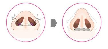 鼻翼缩小手术的过程是怎样进行的