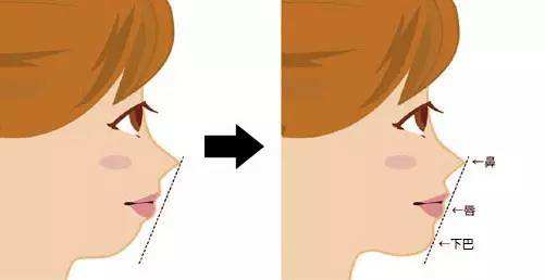 假体隆鼻失败的原因和修复方法