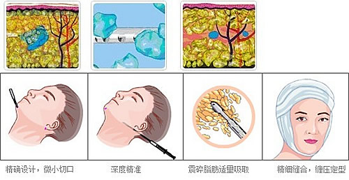 面部吸脂瘦脸的优势有哪些