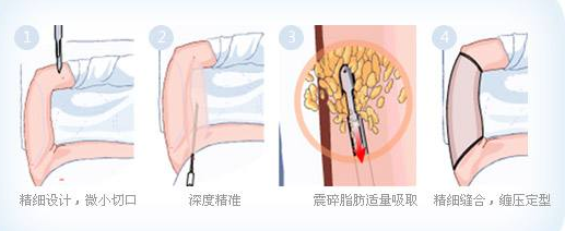 手臂吸脂手术一般需要多少钱