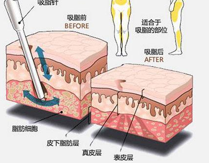 大腿吸脂有副作用吗