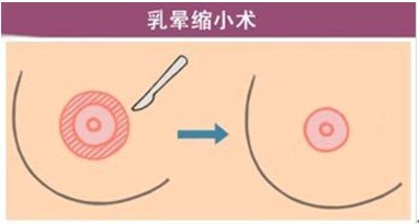 乳晕缩小手术会痛吗