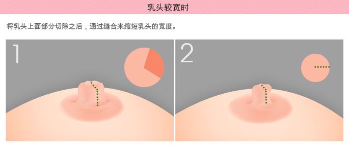 乳头缩小术的效果怎么样