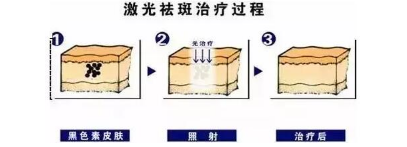 激光祛斑过程