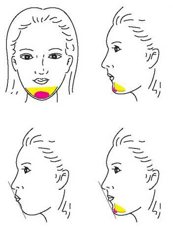下巴整形手术选哪一种好