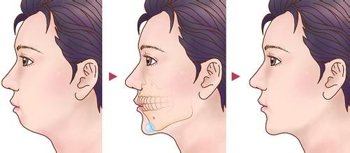 下巴整形的价格到底是多少