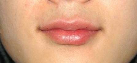 嘴唇整形有哪些方法