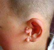 副耳切除的手术方法是什么