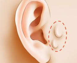 副耳切除的手术方法是什么