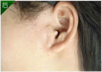 副耳切除会不会影响听力