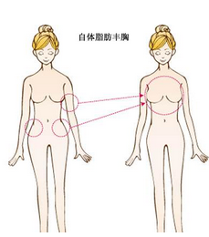 自体脂肪隆胸好吗