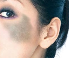 上海激光去胎记怎么样呢