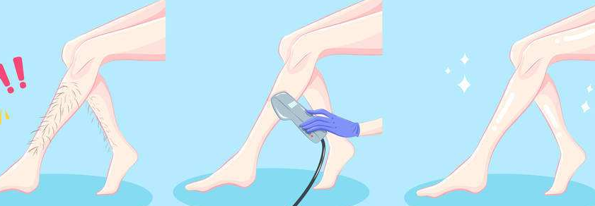 激光腿部脱毛的原理