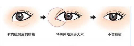 开内眼角手术会留疤吗