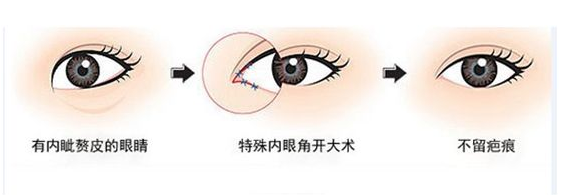 开内眼角手术的原则是哪些