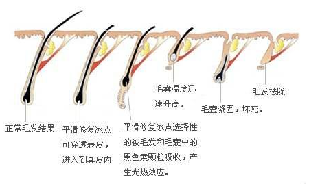 艺星脱毛原理