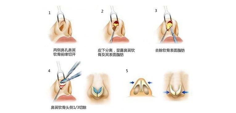 鼻头比较大怎么办