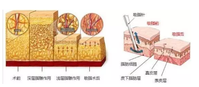 360°水动力吸脂