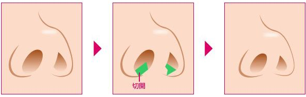 鼻部整形是很常见的整形美容手术，然而由于手术方式的多元化，很多爱美人士都会很担心，手术后，