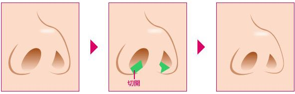 鼻部整形是很常见的整形美容手术,然而由于手术方式的多元化,很多爱美人士都会很担心,手术后,
