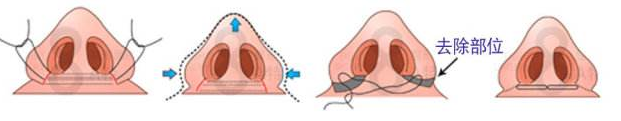 鼻部整形是很常见的整形美容手术，然而由于手术方式的多元化，很多爱美人士都会很担心，手术后，