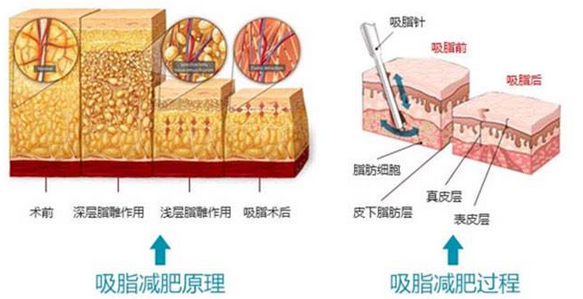 吸脂过程图示