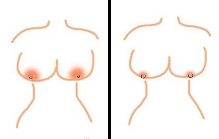 上海乳晕缩小术怎么样