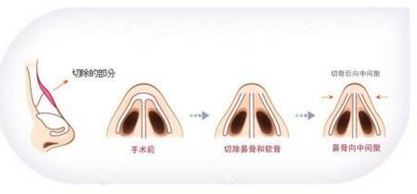 驼峰鼻矫正