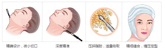 艺星吸脂瘦脸原理