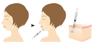玻尿酸丰下巴原理