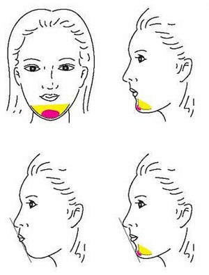 假体垫下巴效果怎样