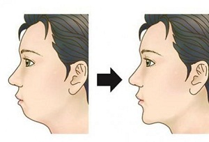 假体垫下巴效果怎样