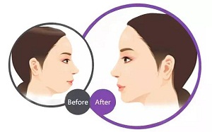 假体垫下巴效果怎样