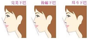 假体丰下巴有后遗症吗