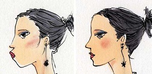 硅胶下巴取出后能打玻尿酸吗