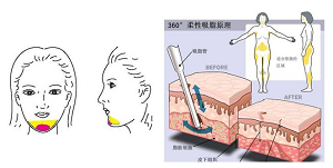 双下巴吸脂效果怎么样呢