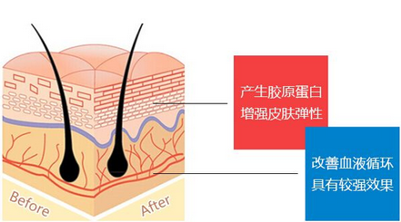 线雕改善肤质