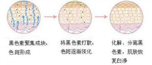 激光祛斑原理