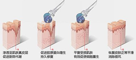 激光去痘印原理图示