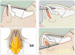 驼峰鼻矫正