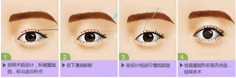 双眼皮手术过程图示