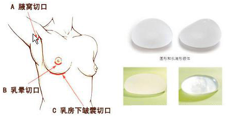 假体隆胸图示