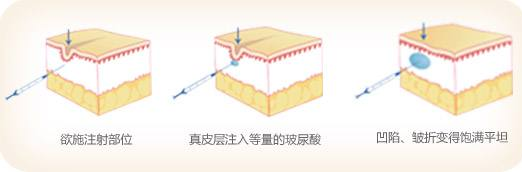 玻尿酸